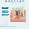 New a dental implant