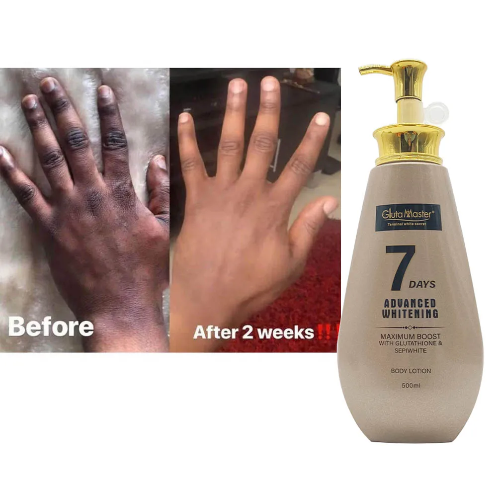 glutathione stretch marks Stretch Marks Treatment