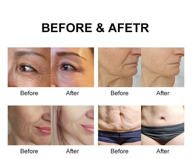 Máquina de belleza portátil Hi Fu 12D para rostro y cuerpo, ultrasonido focalizado de alta intensidad, máquina de ultrasonido 12D, máquina de lifting Smas