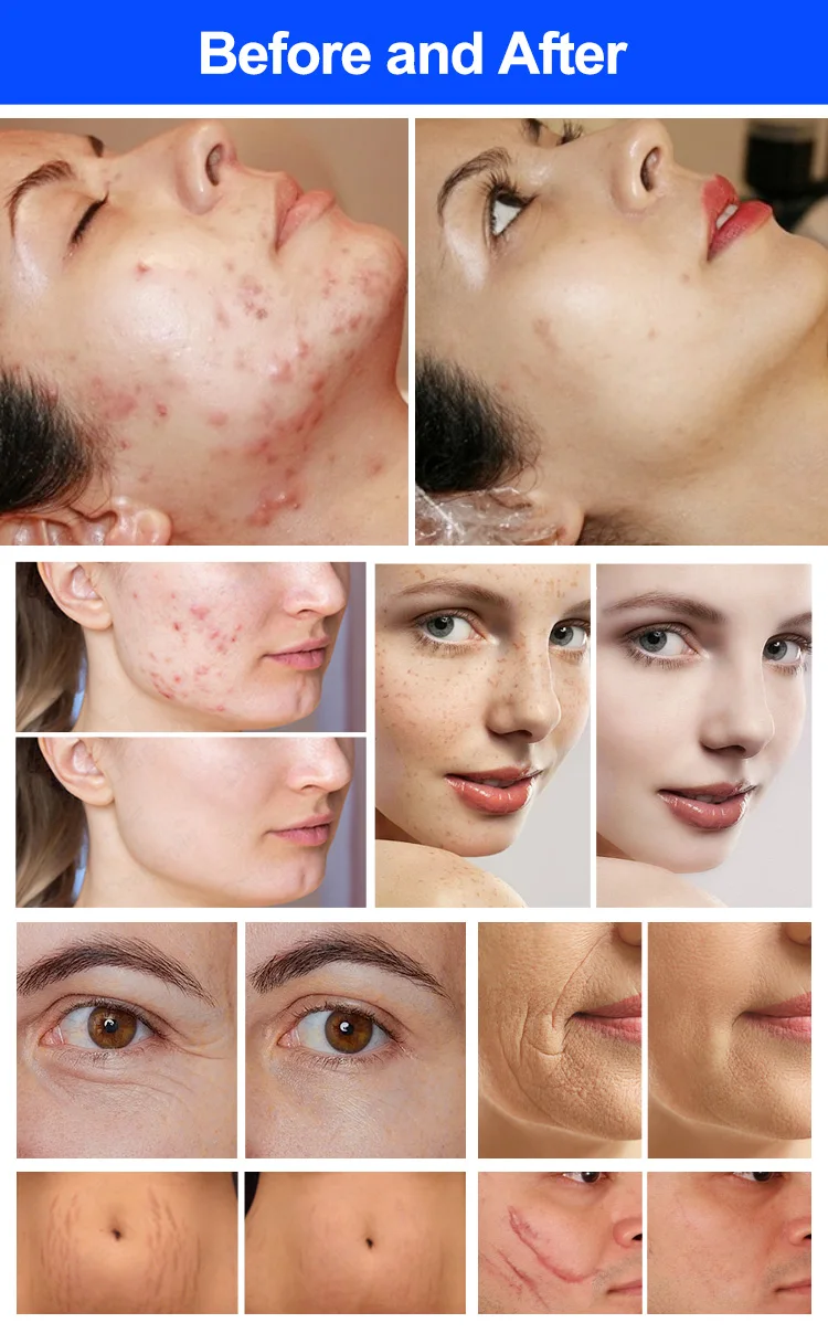 Portable 60W 10600nm Fractional CO2 Laser for Skin Rejuvenation Acne Stretch Mark Removal with RF Metal Tube Co2 Laser Cutting