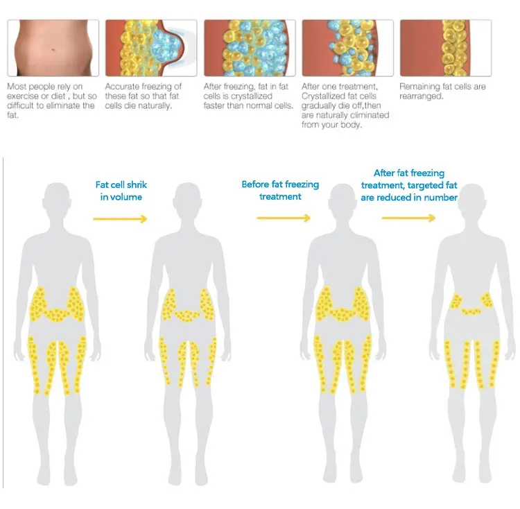 <p data-pm-slice="1 3 []">The Portable Cryo Fat Freezing Machine is designed for professional aesthetic businesses offering targeted body-contouring treatments. Supplied with three interchangeable cryolipolysis applicators, it supports treatment planning for different body areas, from the abdomen and waist to the buttocks, legs, arms and double chin.</p> With three applicator sizes in one compact system, practitioners can select an appropriate handle according to the treatment area and individual client assessment. This versatile configuration makes the machine a practical option for beauty salons, Med Spas and body-contouring studios looking to expand their non-invasive aesthetic service offerings. <strong>Included Applicators:</strong> <ul data-spread="false"> <li>Big Cryo Handle: 17 × 10 cm — abdomen and waist</li> <li>Medium Cryo Handle: 14 × 5.5 cm — buttocks and legs</li> <li>Small Cryo Handle: 8 × 4 cm — double chin and arms</li> </ul> Portable Cryo Fat Freezing Machine with 3 Handles for Professional Body Contouring