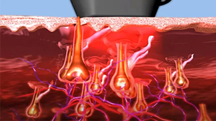 Ce Approved New Generation 3 Waves Portable 755nm 808nm 1064nm Portable Diode Laser Hair Removal Machine