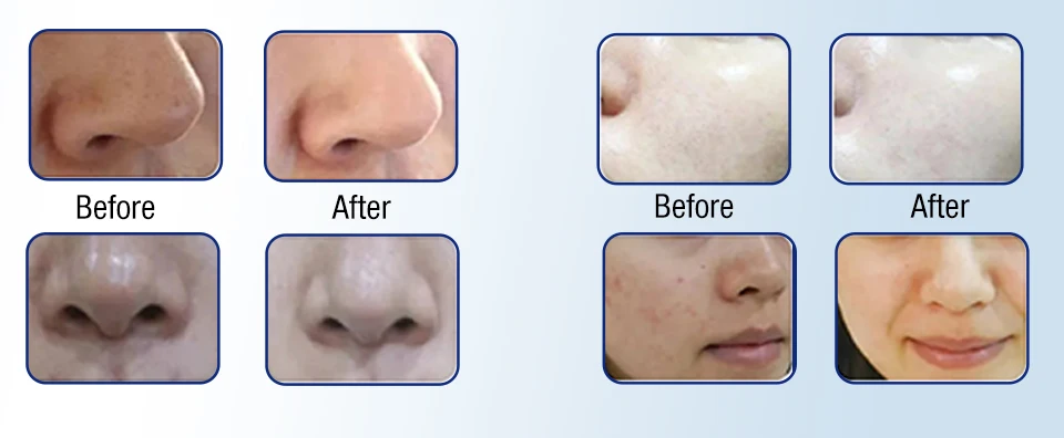 hydrafacial machine before and after