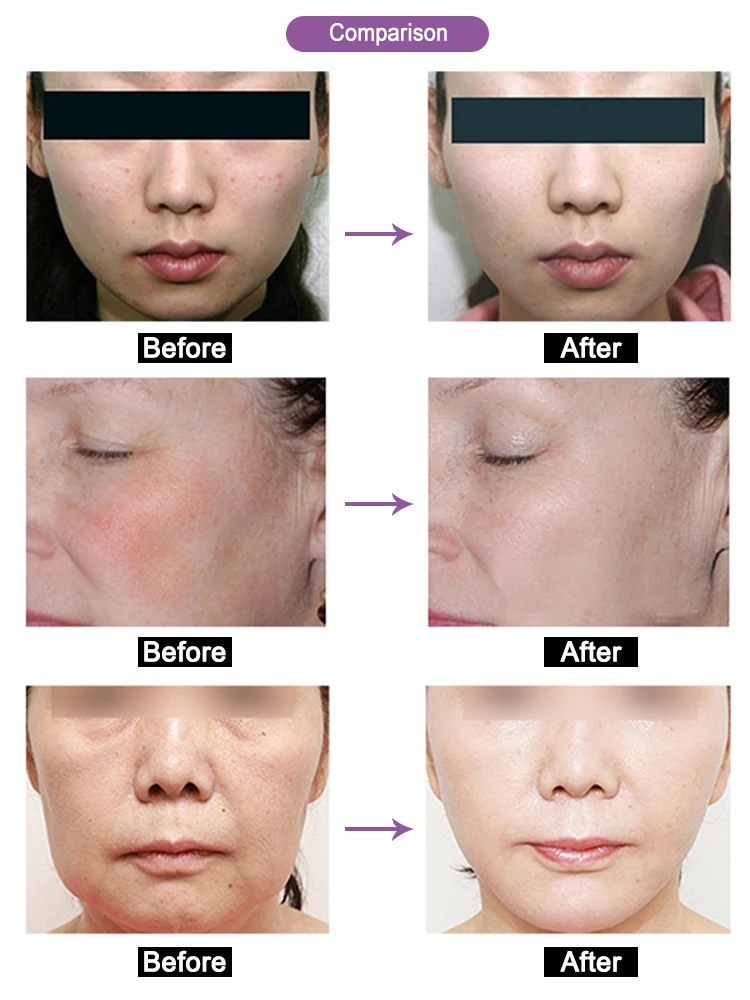 PDT 4 Colors LED Light Therapy Machine Infrared LED Facial Beauty Device for Skin Rejuvenation