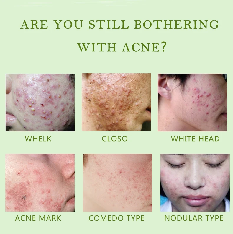 One Day Can See Result Oil Control Acne Treatment Chinese Herbal Cream For Acne Buy Chinese Herbal Cream For Acne Chinese Creams For Skin 5 Day Acne Cream Product On Alibaba Com