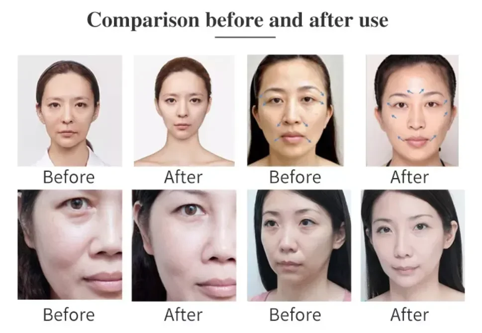 2024 professional anti aging anti-wrinkle machine Face Lift face firming Wrinkle Remover smas mfu rf skin beauty salon machine