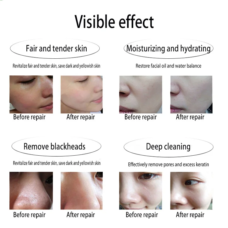 Microdermabrasion Blackhead Remover Hydra Moisturizer Ice Water Face Device Facial Hydro Water Jet Peel For Face Deep Cleaning