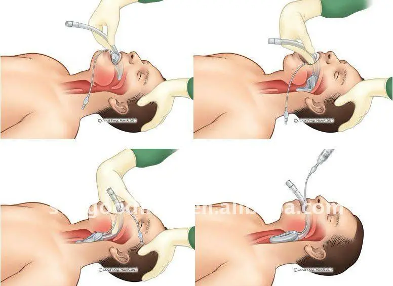 SUNGOOD High Performance New Design Silicone Laryngeal Mask Airway Reinforced Tube ISO Quality Certification Adults' Airway EOS