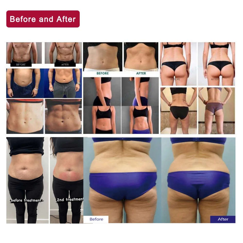 Cryolipolysis Machine with 8 Cryo Paddles for Fat Reduction & Body Sculpting 12 Discover the professional Cryolipolysis Machine with 8 Cryo Paddles for non-invasive fat freezing, body contouring, slimming, and salon body sculpting treatments. Designed for aesthetic clinics, med spas, and beauty salons seeking advanced multi-handle cryotherapy technology. Cryolipolysis Machine with 8 Cryo Paddles for Fat Reduction & Body Sculpting