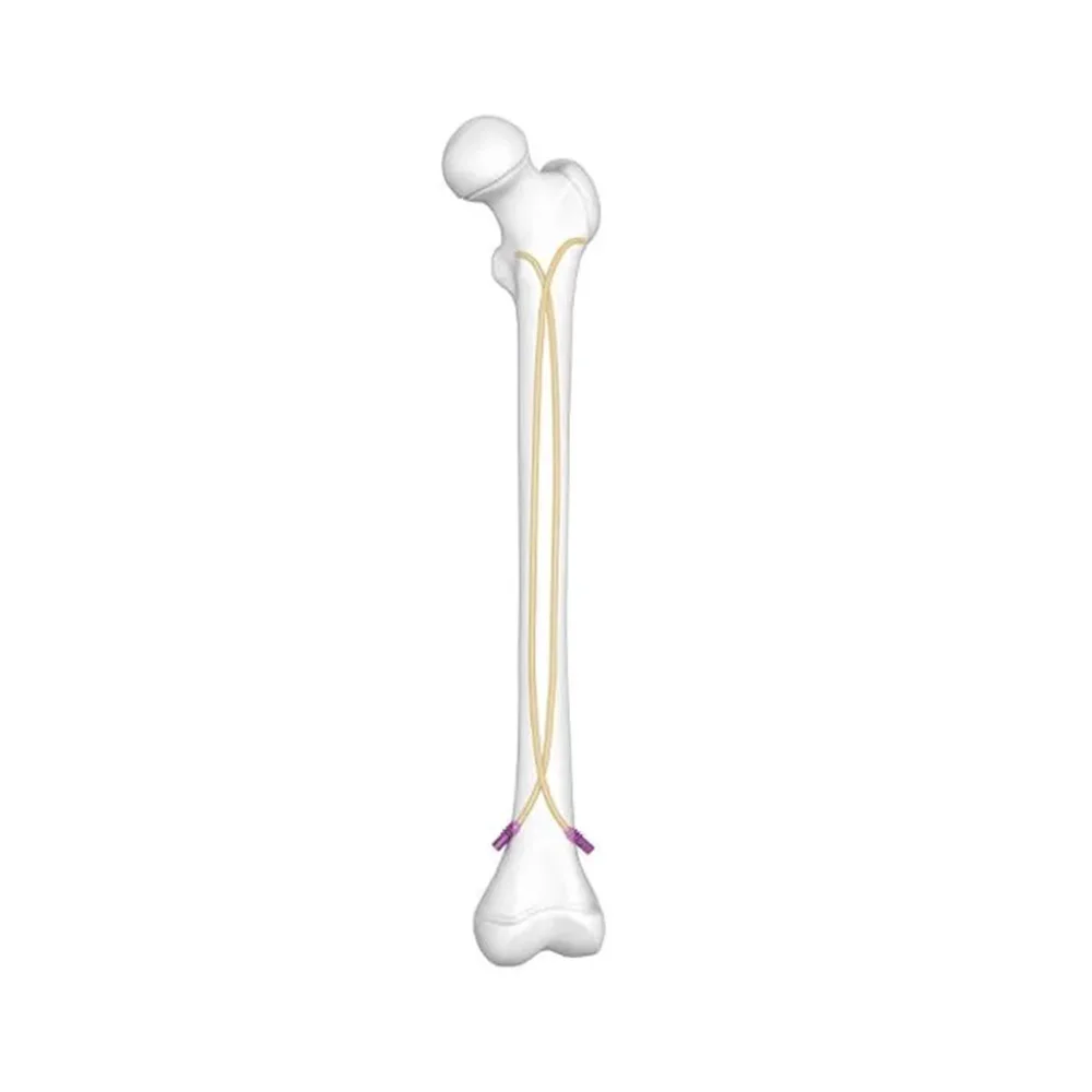 Elastic Nail