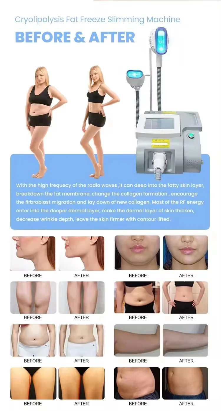 <p data-pm-slice="1 3 []">The Portable Cryo Fat Freezing Machine is designed for professional aesthetic businesses offering targeted body-contouring treatments. Supplied with three interchangeable cryolipolysis applicators, it supports treatment planning for different body areas, from the abdomen and waist to the buttocks, legs, arms and double chin.</p> With three applicator sizes in one compact system, practitioners can select an appropriate handle according to the treatment area and individual client assessment. This versatile configuration makes the machine a practical option for beauty salons, Med Spas and body-contouring studios looking to expand their non-invasive aesthetic service offerings. <strong>Included Applicators:</strong> <ul data-spread="false"> <li>Big Cryo Handle: 17 × 10 cm — abdomen and waist</li> <li>Medium Cryo Handle: 14 × 5.5 cm — buttocks and legs</li> <li>Small Cryo Handle: 8 × 4 cm — double chin and arms</li> </ul> Portable Cryo Fat Freezing Machine with 3 Handles for Professional Body Contouring