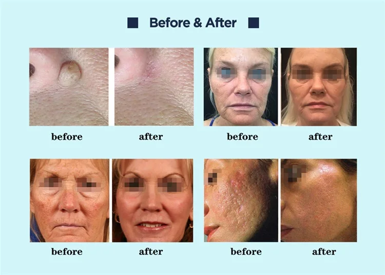 Equipo láser fraccional de CO2 de alta calidad ADSS, máquina quirúrgica de  fracción de piel láser CO2 para uso en spa de belleza