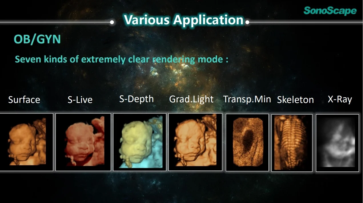 ソノスケープS50超音波診断装置 3D 4D S-LiveおよびS-Depth心エコー検査とIMT測定