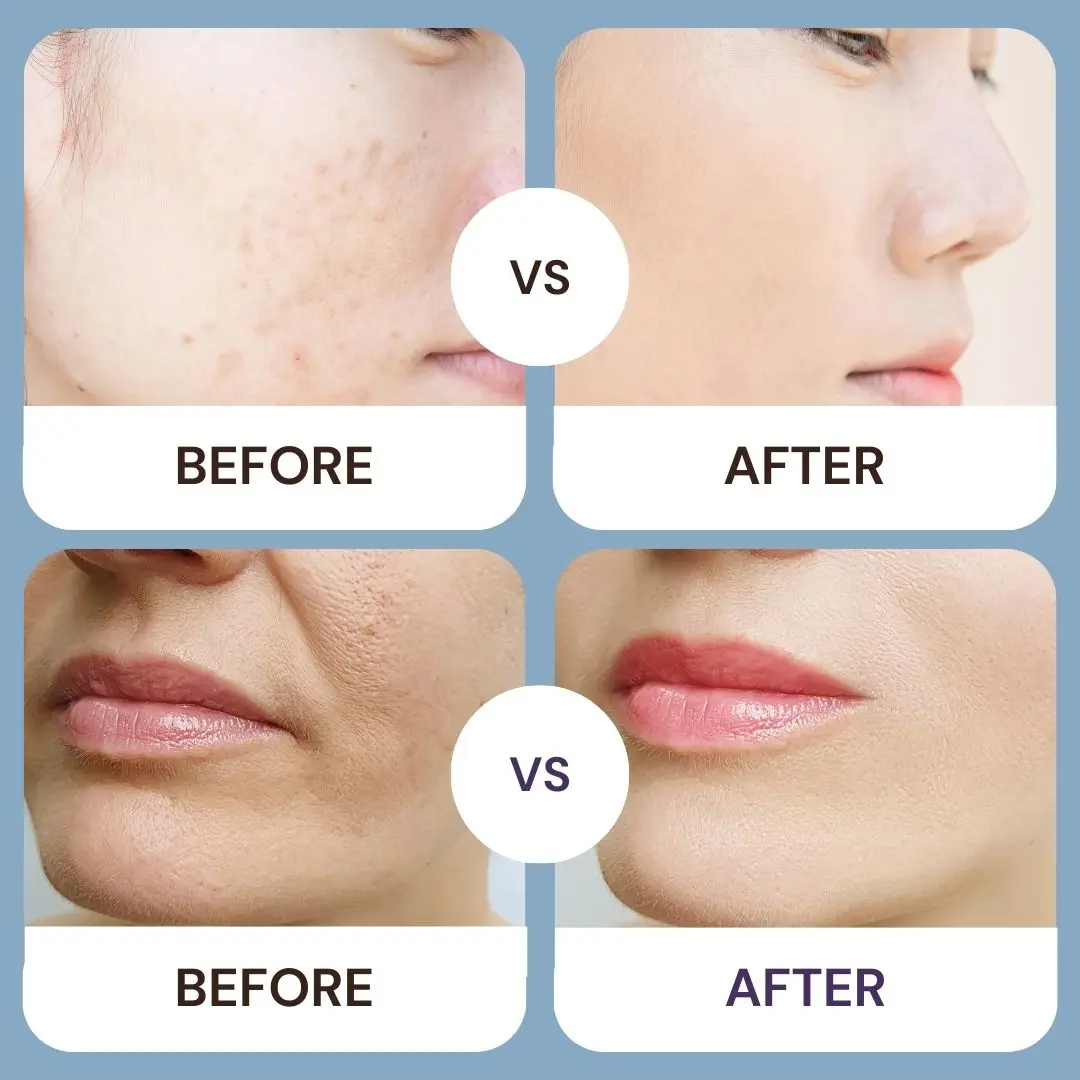Reedle Shot Serum with Micro-Needle Formula Aloe Vera Infused Seaweed Green Tea & Vitamin B5 Whitening Acne Scar Repair