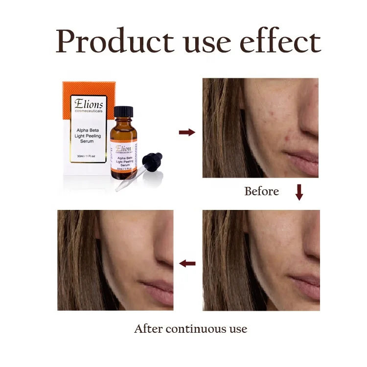 Oem Glycolic Lactic 30 Salicylic Acids 2 Blackhead Pimple Treatment