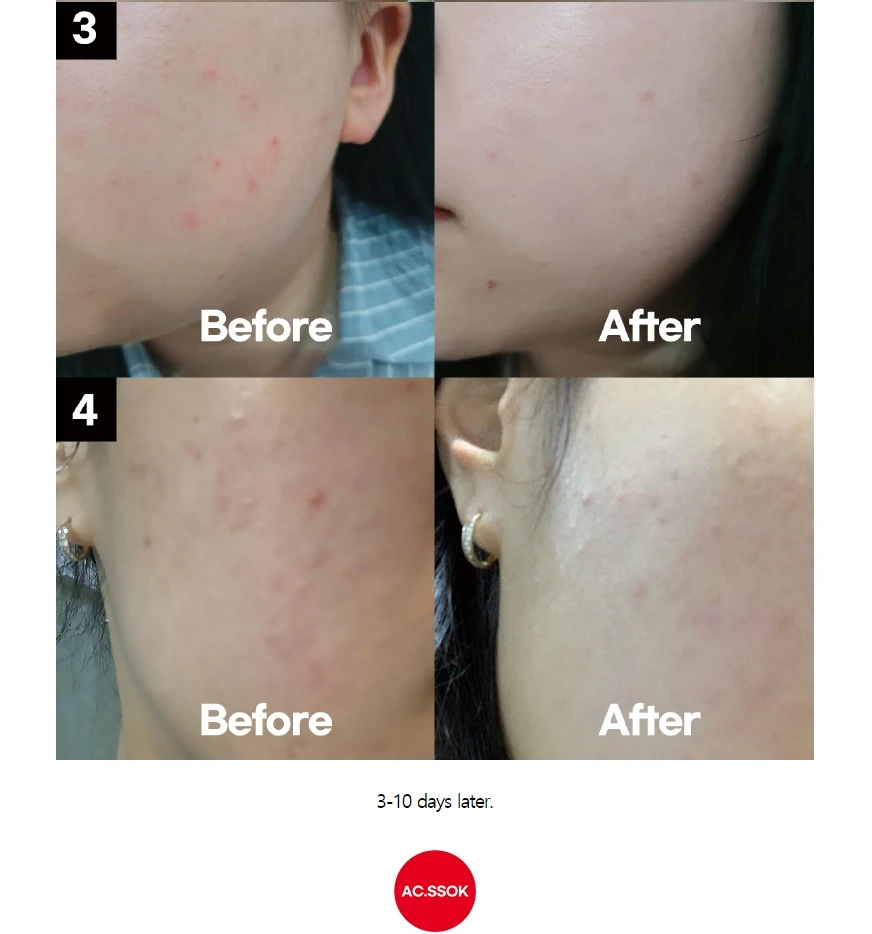 serum for comedonal acne