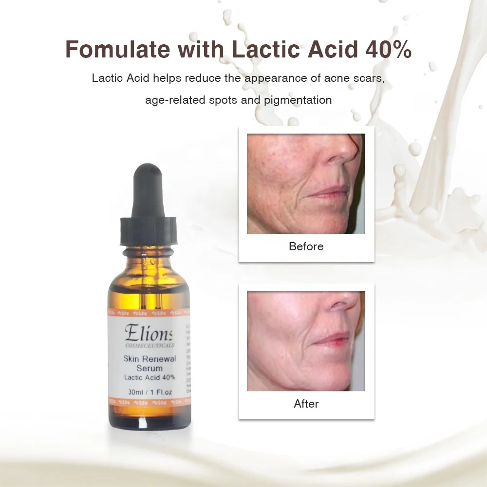 Minimizing Areas Of Discoloration 40% Lactic Acid Increase Collagen ...