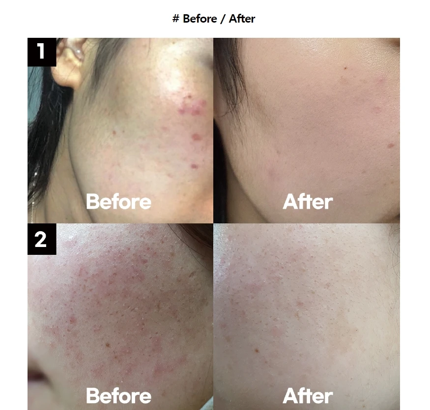 serum for comedonal acne